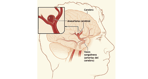 Brain Aneurysm