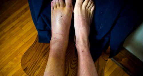 Broken Ankle