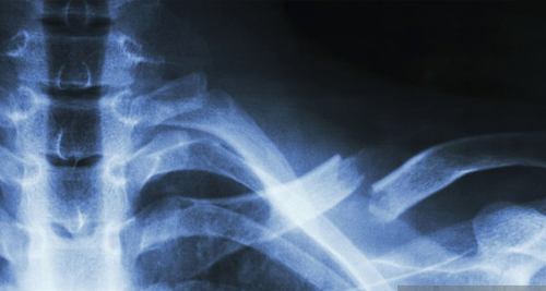 Broken Collarbone