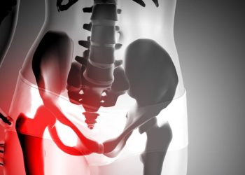 X-ray illustration of a broken hip showing inflammation in the pelvic region