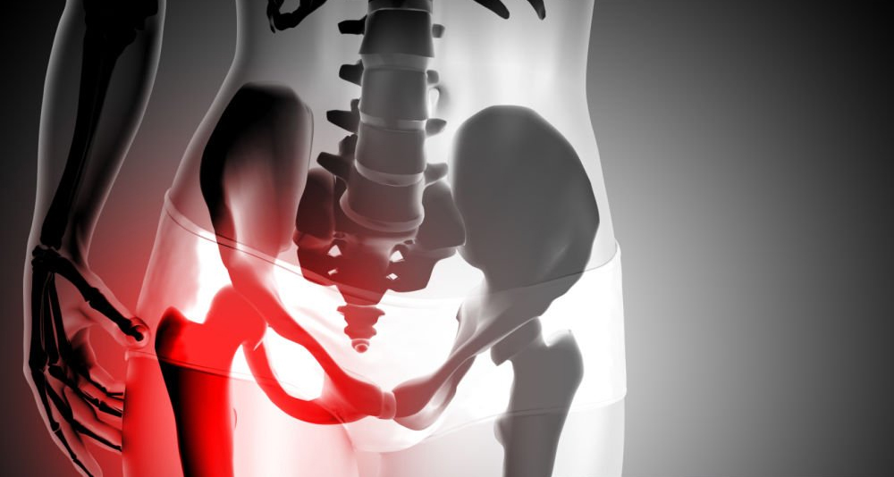X-ray illustration of a broken hip showing inflammation in the pelvic region