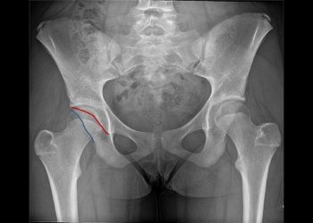 Pelvic X-ray showing fracture lines marked in red and blue