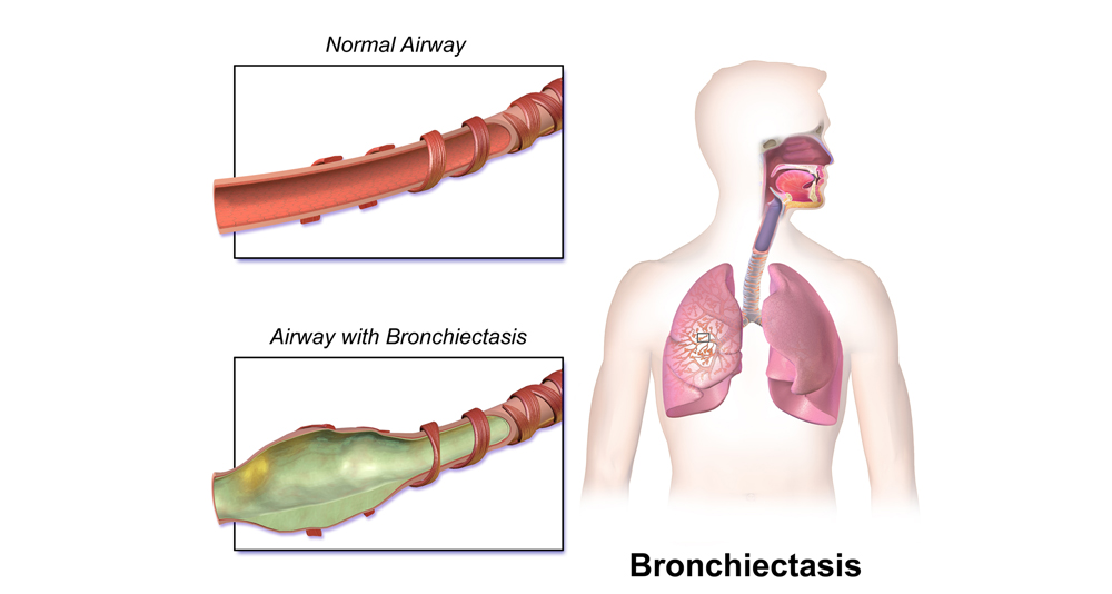 Medical illustration comparing normal airway to an airway affected by bronchiectasis