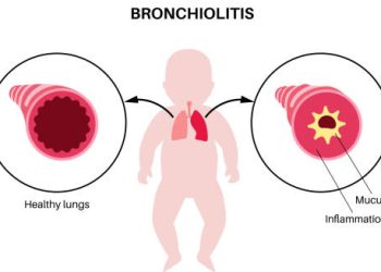 Infographic showing bronchiolitis in infants with comparison of healthy lungs and inflamed airways