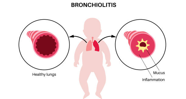 Infographic showing bronchiolitis in infants with comparison of healthy lungs and inflamed airways