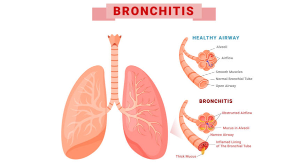 Medical illustration showing healthy lungs versus lungs affected by bronchitis