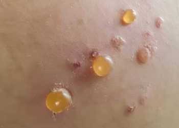 Cluster of fluid-filled blisters on inflamed skin caused by bullous pemphigoid