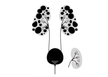 Illustration of kidneys with multiple cysts representing Autosomal Dominant Polycystic Kidney Disease (ADPKD) and genetic cause.