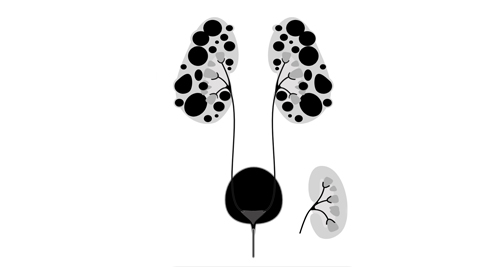 Illustration of kidneys with multiple cysts representing Autosomal Dominant Polycystic Kidney Disease (ADPKD) and genetic cause.