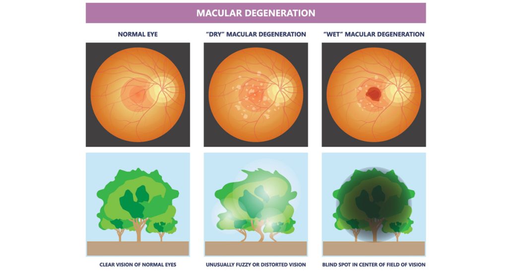 Causes and Risk Factors of AMD