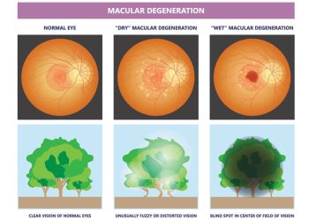 Causes and Risk Factors of AMD