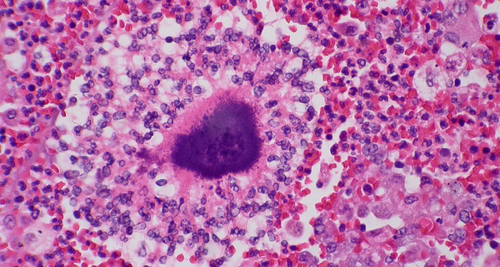 Causes and Risk Factors of Actinomycosis