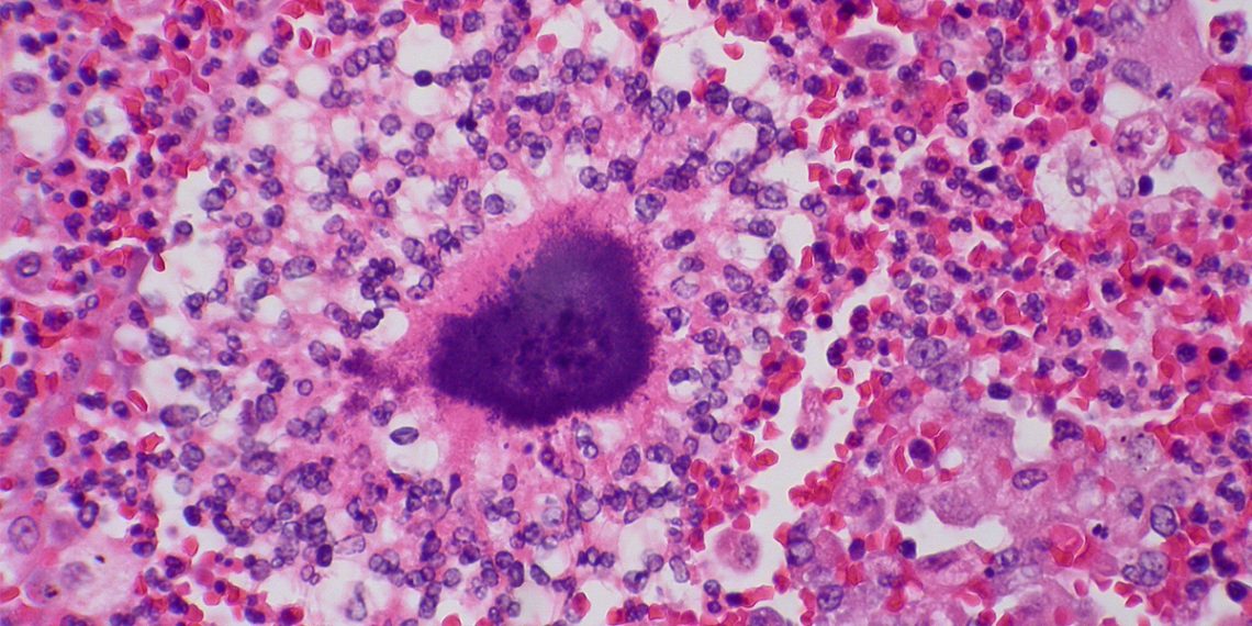 Causes and Risk Factors of Actinomycosis