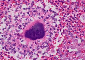 Causes and Risk Factors of Actinomycosis