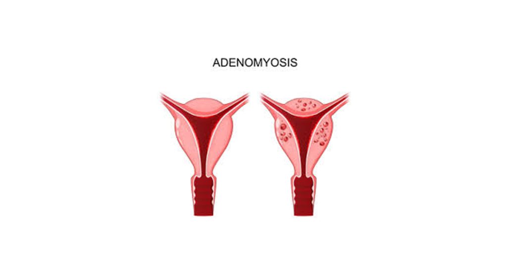 Causes and Risk Factors of Adenomyosis