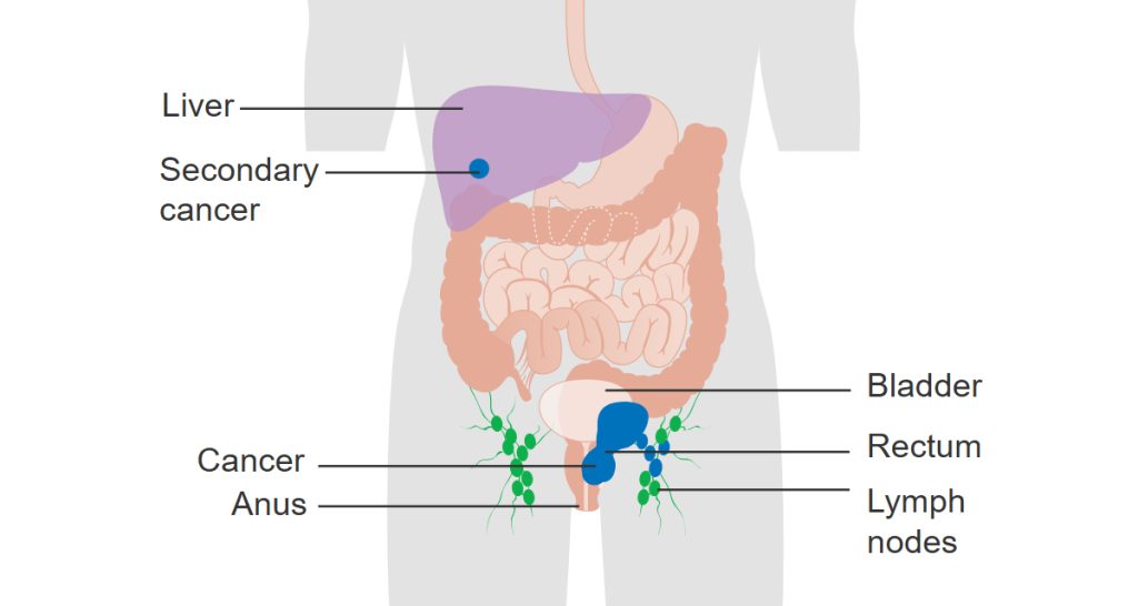 Causes and Risk Factors of Anal Cancer