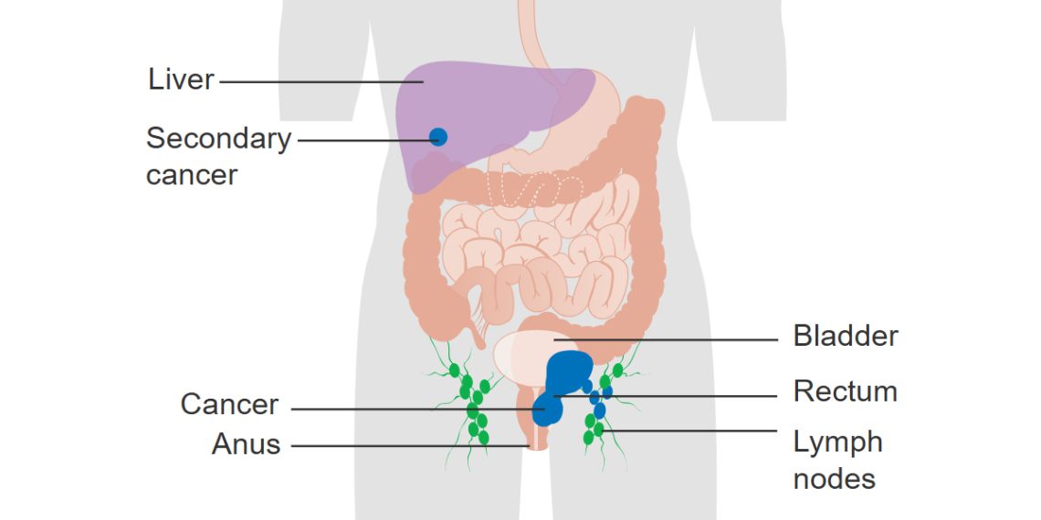 Causes and Risk Factors of Anal Cancer