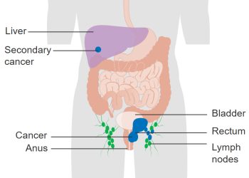 Causes and Risk Factors of Anal Cancer