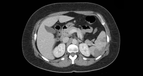 Causes and Risk Factors of Antiphospholipid Syndrome
