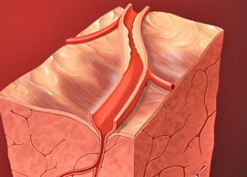 Causes and Risk Factors of Atrial Fibrillation