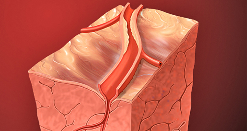 Causes and Risk Factors of Atrial Fibrillation