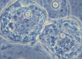 Microscopic image showing bacterial imbalance in vaginal flora linked to bacterial vaginosis.