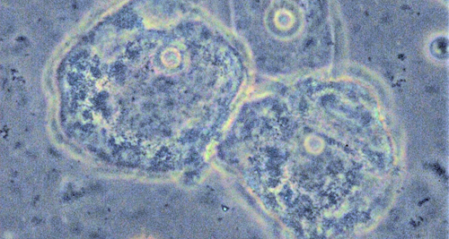 Microscopic image showing bacterial imbalance in vaginal flora linked to bacterial vaginosis.
