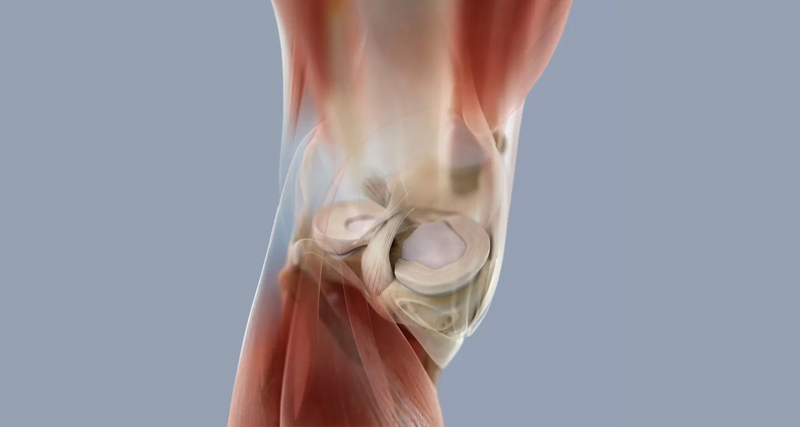 Anatomical illustration of the knee joint showing underlying structures associated with the development of a Baker’s cyst.