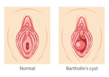 Medical illustration comparing normal anatomy to Bartholin’s cyst with visible gland swelling.