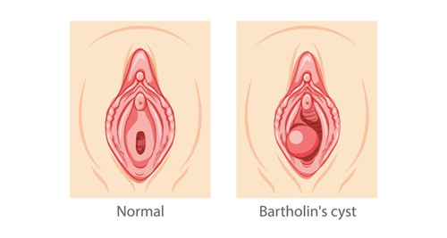 Medical illustration comparing normal anatomy to Bartholin’s cyst with visible gland swelling.