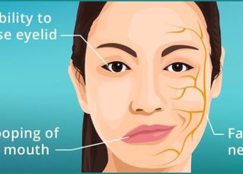Illustration of a woman showing symptoms of Bell’s palsy, including facial droop and eyelid weakness, with facial nerve pathways highlighted.