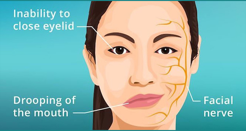 Illustration of a woman showing symptoms of Bell’s palsy, including facial droop and eyelid weakness, with facial nerve pathways highlighted.