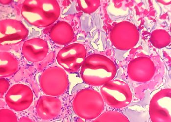 Microscopic view showing red and pink crystalline structures representing bladder stone formation in biological tissue.