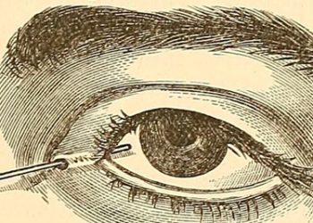 Illustration of an eye being examined for blepharitis using a fine instrument at the eyelid margin.