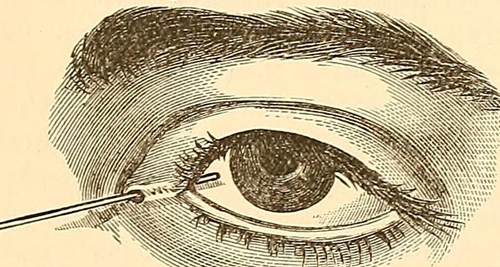 Illustration of an eye being examined for blepharitis using a fine instrument at the eyelid margin.