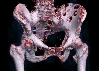 3D bone scan showing widespread bone lesions indicative of cancer affecting the pelvis and lower spine.