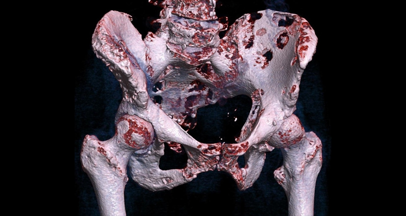 3D bone scan showing widespread bone lesions indicative of cancer affecting the pelvis and lower spine.