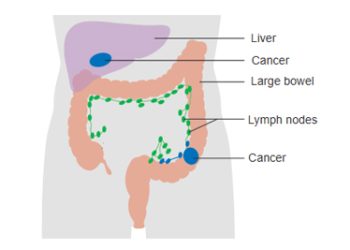 Diagram showing bowel cancer affecting large bowel, lymph nodes, and liver