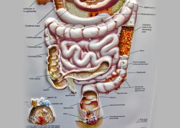 Medical illustration of the digestive tract highlighting causes and locations of bowel polyps