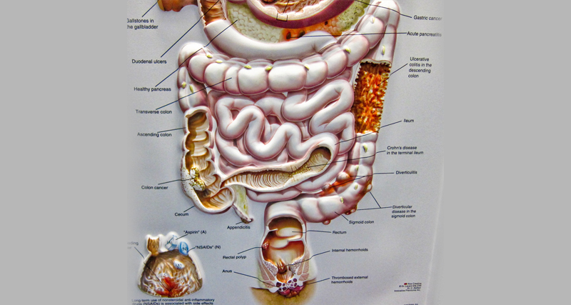 Medical illustration of the digestive tract highlighting causes and locations of bowel polyps