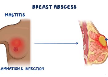Causes and Risk Factors of Breast Abscess