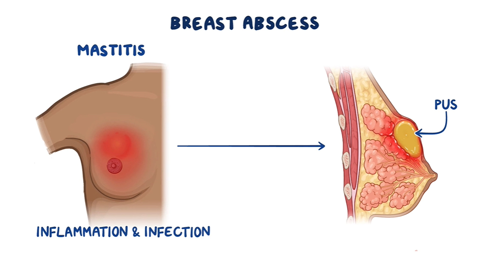Causes and Risk Factors of Breast Abscess