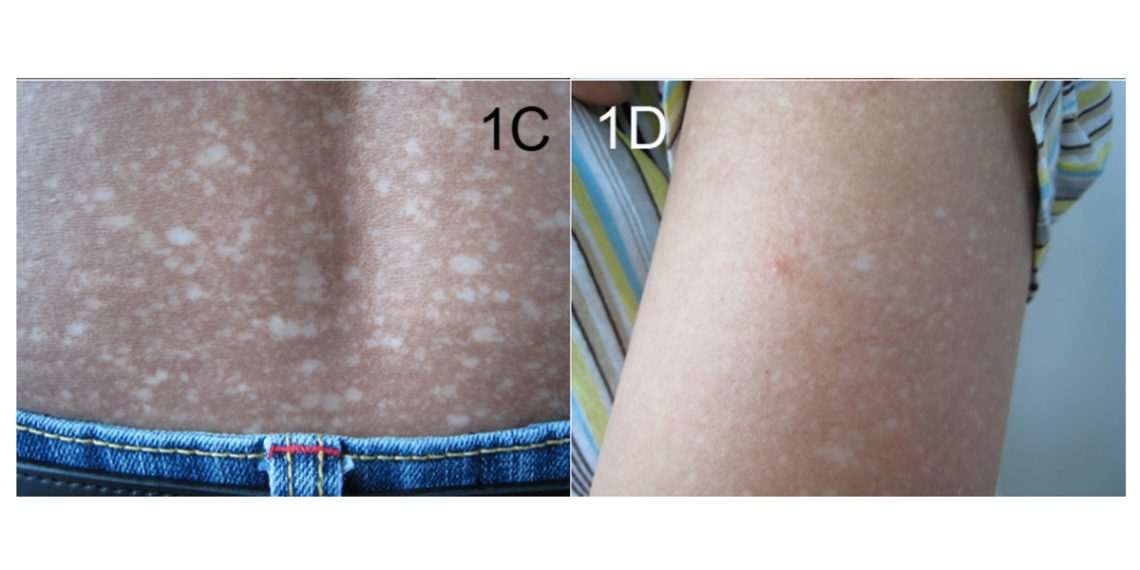 Causes and Types of Amyloidosis