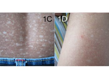 Causes and Types of Amyloidosis