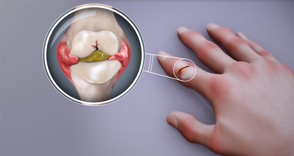 Causes and Types of Arthritis
