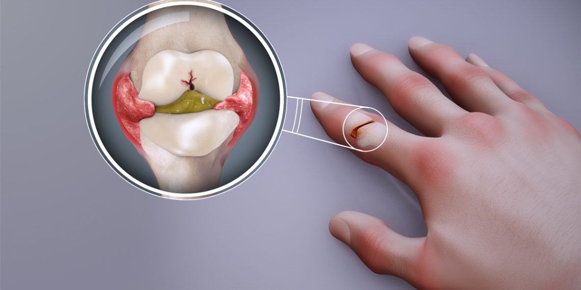 Causes and Types of Arthritis