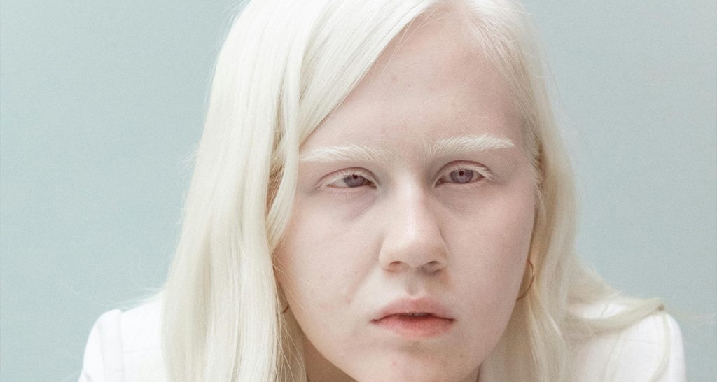 Causes of Albinism