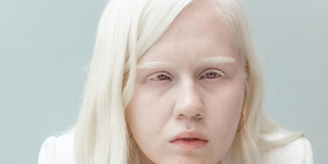 Causes of Albinism