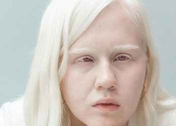 Causes of Albinism