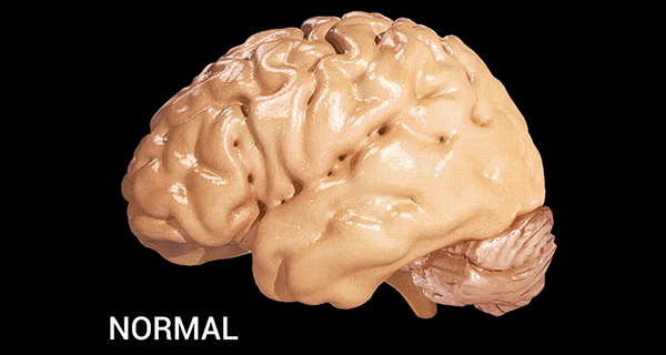 Causes of Alzheimer’s Disease
